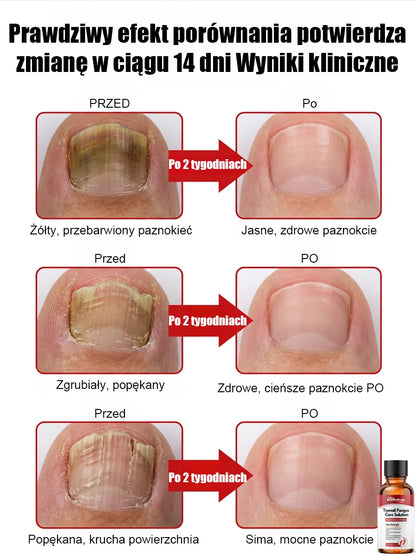 【Bezbolesna wymiana paznokci】Ziołowy łagodny płyn do naprawy paznokci dotkniętych grzybicą
