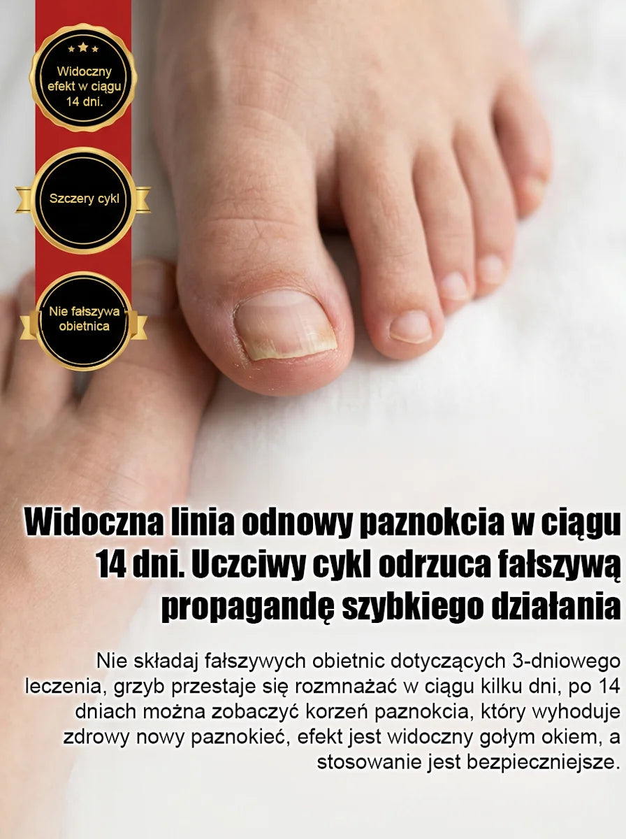 【Bezbolesna wymiana paznokci】Ziołowy łagodny płyn do naprawy paznokci dotkniętych grzybicą